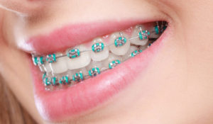 Types of Braces That Exist Today